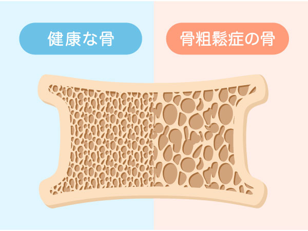 骨粗しょう症　イメージ